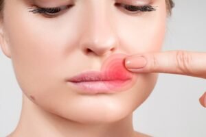 Leia mais sobre o artigo Herpes Labial: 3 Chás para Usar Hoje Mesmo!
