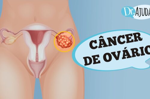 CANCER-DE-OVARIO-SINTOMAS-DIAGNOSTICO-E-TRATAMENTO