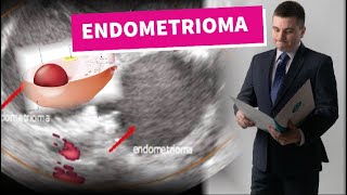Endometrioma-cisto-de-ovario-da-endometriose