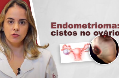 Endometrioma-cistos-de-endometriose-no-ovario