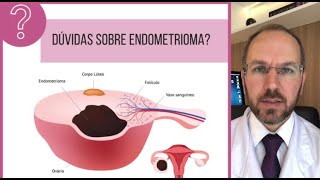Endometrioma