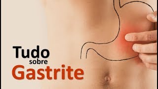 TUDO-SOBRE-GASTRITE-SINAIS-SINTOMAS-E-TRATAMENTO-Dr.-Marcelo-Lima